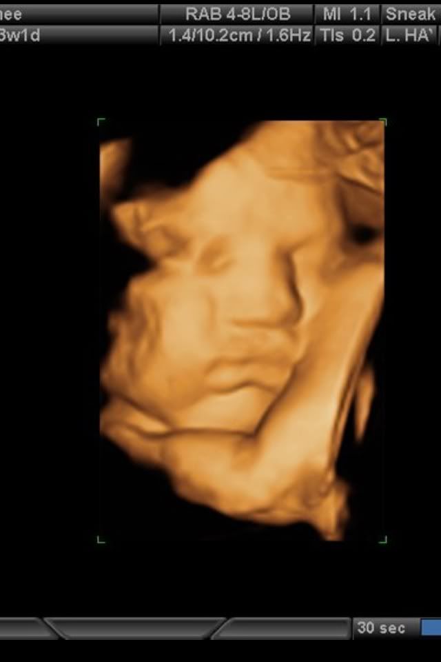 3D ULTRASOUND vs NEWBORN PICS!! | BabyCenter